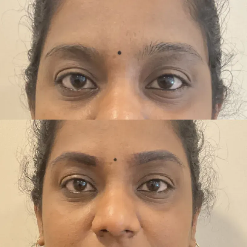 Combination Brows result — Golden Ratio by Priyanka, Bengaluru